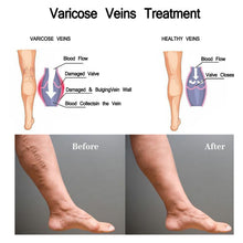 Load image into Gallery viewer, Vein Treatment Varicose Vein Treatment Spray, Leg Varicose Vein Treatment