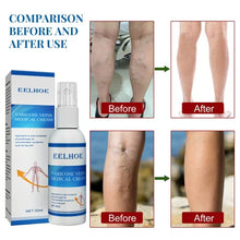 Load image into Gallery viewer, Vein Treatment Varicose Vein Treatment Spray, Leg Varicose Vein Treatment