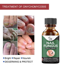 Load image into Gallery viewer, 10ml Oil for Nail Fungus